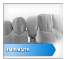 Implante