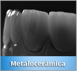 metalocerâmica