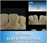 Prótese sobre implante